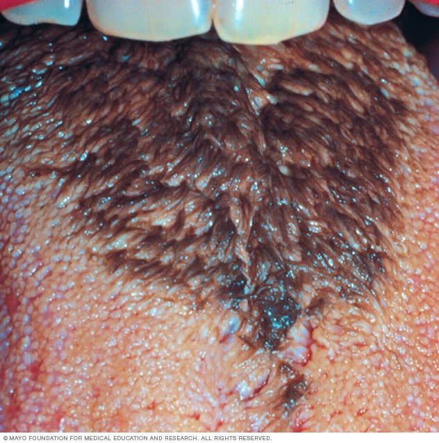 Black hairy tongue, 