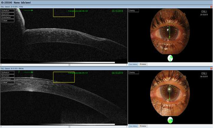 AS OCT showing improvement in corneal thinning with systemic immunosuppressants in secondary sjogrens syndrome