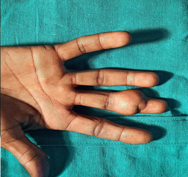 Cyst overlying the middle phalanx causing difficulty to perform the activities of daily living.