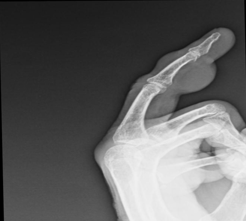 X-ray showing the swelling on middle phalanx with no foreign body.