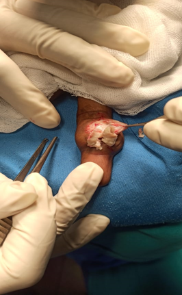 Cheesy material exuding from the cyst.