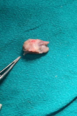 Entire cyst removed along with complete capsule