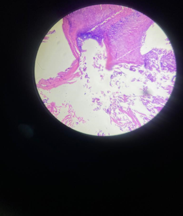 Histopathology slide showing stratified squamous epithelium, with granular layer (blue) and giant cells adjacent to the granular layer and keratin.