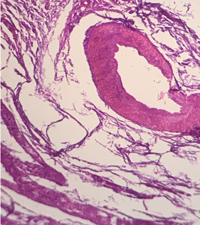 Stratified squamous epithelium along with granular layer, no sebaceous glands are seen on the histopathology exam.