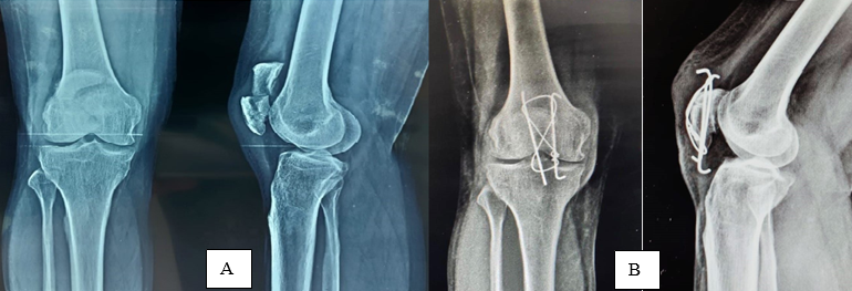 Patients with Tension band wiring A):Pre Operative, B): Post Operative