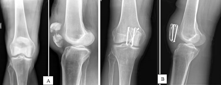 Patients with cannulated cancellous screws: A): Pre operative x-ray, B): Immediate post operative x-ray