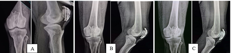 Follow-up of tension band wiring group X- ray A): At 1 months follow-up , B): At 3 months follow-up, C): At 6 month follow-up