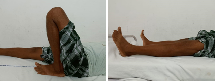 Follow-up of tension band wiring group -clinical photos after final follow-up, A):Flexion, B): Extension 