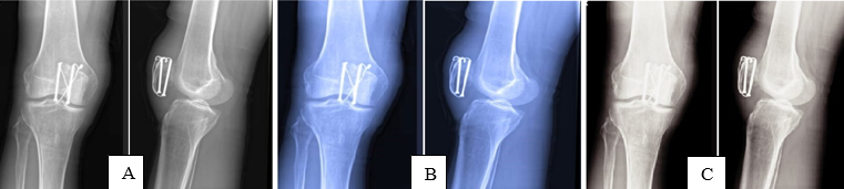 Cannulated cancellous follow up at 6 months follow-up