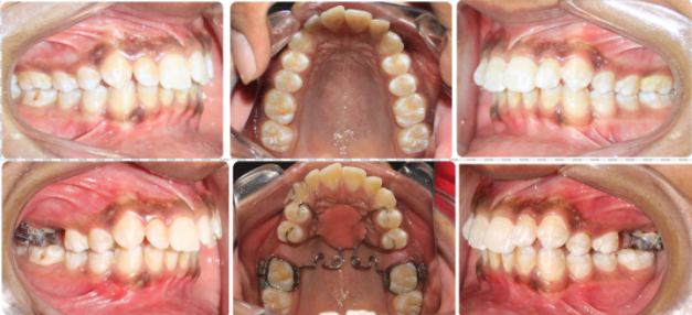 Pre-distalization and post-distalization intraoral photographs using the Pendulum appliance.