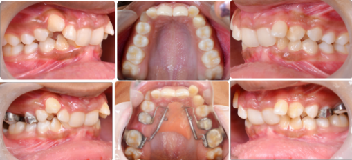 Pre-distalization and post-distalization intraoral photographs using the Distal jet appliance.