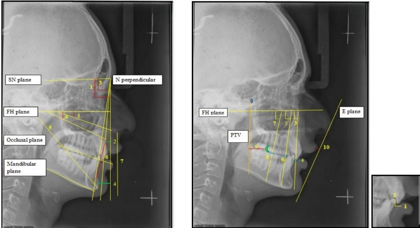 Skeletal & dental and soft tissue cephalometric measurements.