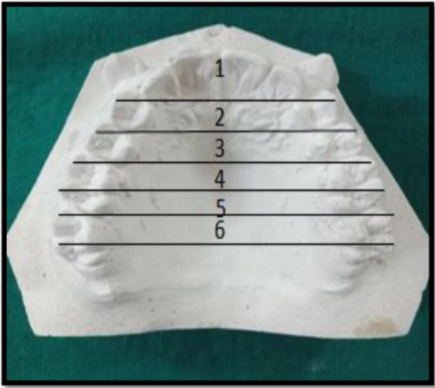 Measurements for dental cast analysis. 1-Distance between buccal cusp tips of upper first premolars. 2-Distance between buccal cusp tips of upper second premolars. 3-Distance between buccal cusp tips of mesio-buccal cusps of upper first molars. 4-Distance between buccal cusp tips of disto-buccal cusps of upper first molars. 5-Distance between buccal cusp tips of mesio-buccal cusps of upper second molars. 6-Distance between buccal cusp tips of disto-buccal cusps of upper second molars.