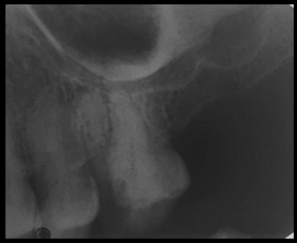 Pre-operative radiograph