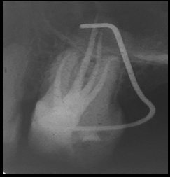 Post-operative radiograph 