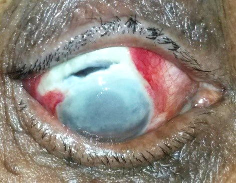 Wound gape with uveal show