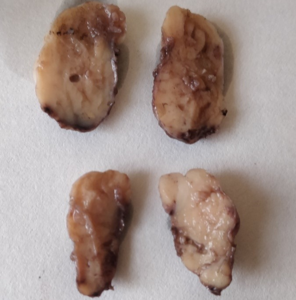 Gross picture showing homogenous, grey white cut section of both globular tissue pieces
