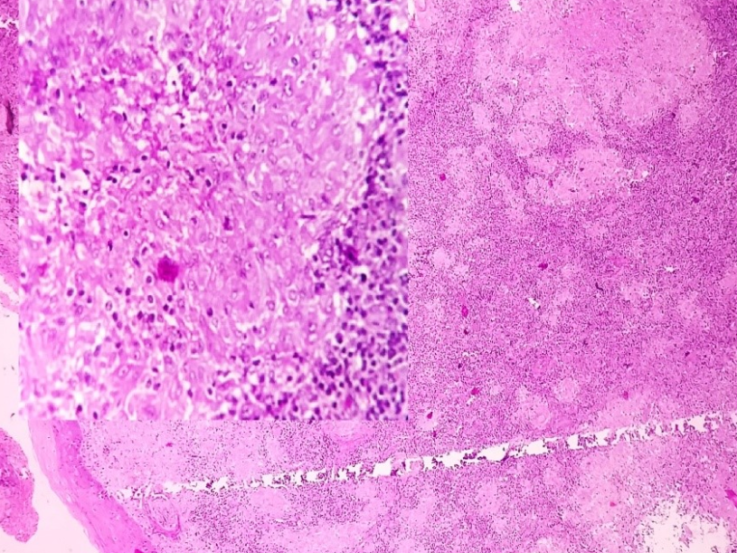 Microphotograph showing stratified squamous epithelium and partially effaced tonsillar architecture (H&E X 100). Inset showing epithelioid cell granuloma.