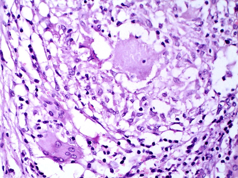 Microphotograph showing granuloma with Langhans giant cells. (H&E X 400)