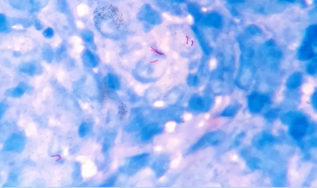 Microphotograph showing Acid fast bacilli (ZN stain, Oil immersion)
