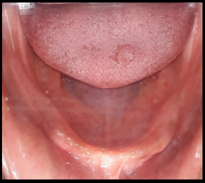 Resorbed mandibular ridge