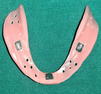 Stops on tissue surface