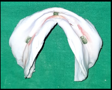 Definitive mandibular impression