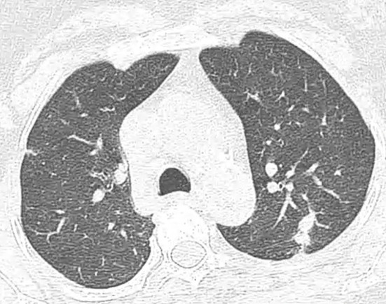 Contrast enhanced CT thorax showing bilateral, multiple mediastinal and parenchymal enlarged lymph nodes.