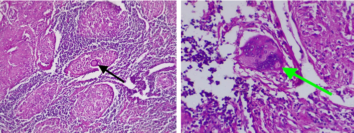 a and b: Histopathological findings in left image showing non-caseating granulomatous lymphadenitis with giant cells (black arrow), and right image showing giant cell containing schaumann bodies and asteroid bodies (green arrow) in the cytoplasm.