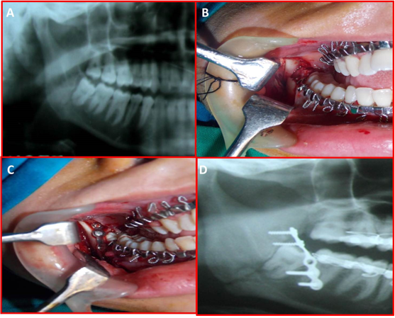 A patient treated with miniplate fixation. A) Radiograph showing Mandibular Angle Fracture. B) Intra Oral Exposure of Mandibular Angle Fracture. C) Intra Oral Miniplate Fixation. D) Post-Operative Radiograph