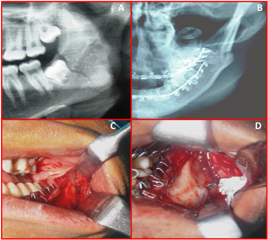 A patient treated with Lag Screw fixation A) Orthopantamogram showing Mandibular Angle Fracture. B) PA skull showing Mandibular Angle Fracture. C) Intra Oral Exposure of Mandibular Angle Fracture. D) Intra Oral Lag Screw Fixation.