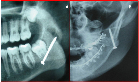 Post-operative radiograph showing lag screw fixation A) Orthopantamogram. B) PA skull.