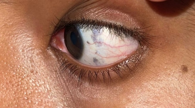 Multiple dark blue colored macules present over the left sclera.
