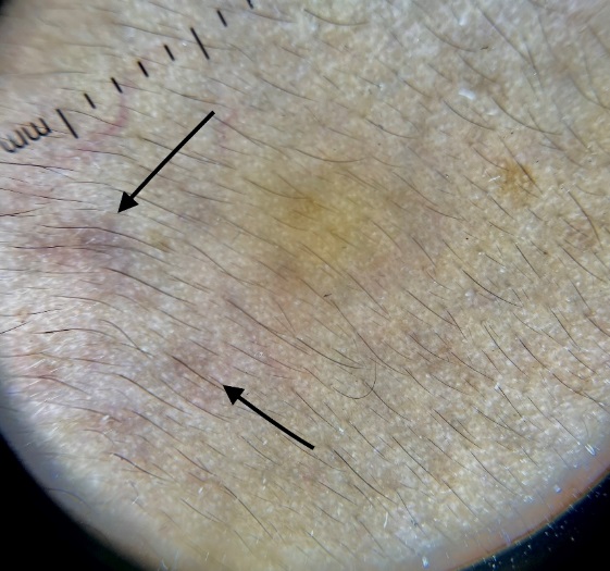 On dermoscopy, speckled homogenous pattern with blue gray discoloration is seen over the areas of pigmentation on the bilateral malar areas.