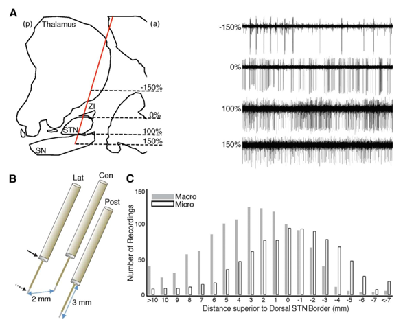 MER acquisitions of basal ganglion; A: Sagittal-view-of a sample trajectory-path (red-colored slope from the area of SN to thalamus) to the direction of sub thalamic nuclei, going across thalamus, ZI, followed by SN. Right-side showing the M E R signals/waveforms determine usual cell-recordings from these cortico and subcortical structures; B: 3electrodes asynchronously, i.e., parallelly and concurrently too were progressive, unglued as of all other in the 4 directions, namely,frontal, lateral, median, or cross with 2mm apart; C: Aggregate of inferred macro electrode (for macro stimulation) /microelectrode recordings (for micro electrodes) at every individually recording the intensity (depth) or complexity (or gravity) through all routes(trajectories) indicating S.T.N-M.E.R.s.