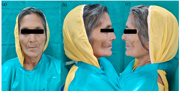 (a) Front profile, (b) Right lateral profile, (c) Left lateral profile