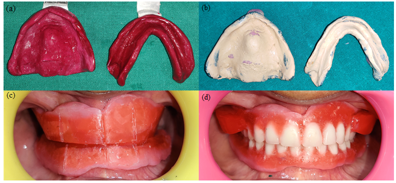 (a) Primary Impression, (b) Secondary Impression (c) Maxillomandibular relation, (d) Try-in with wax cheek plumper