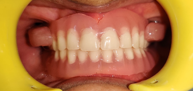 Post rehabilitation intraoral view