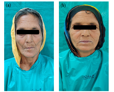 (a) Pre-Rehabilitation view (b) Post-rehabilitatio view