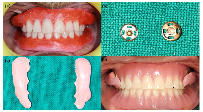 (a) Try-in (b) Male and female counterparts (c) Processed cheek plumpers (d) Post rehabilitative intraoral view