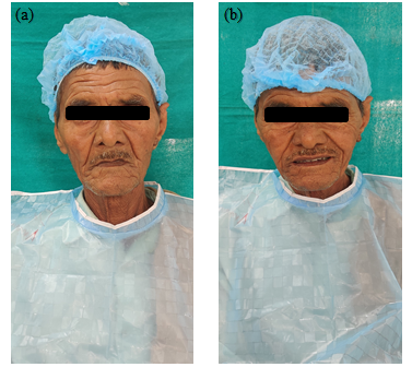 (a) Pre-rehabilitation view (b) Post-rehabilitation view