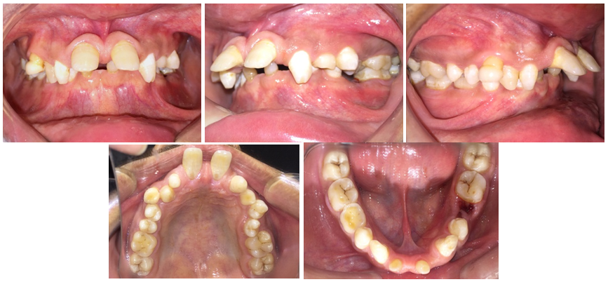 Pretreatment intraoral photographs