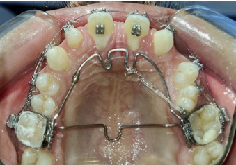 Modified appliance further used to correct rotations 