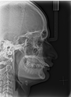 Pretreatment lateral cephalogram