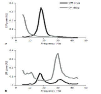 The power spectral density of field-potentials computed with STN-DBS electrodes implanted in two Parkinson’s. (a) PD subject 1: the potency of β-frequency fluctuations is sternly moderated or shrinked by medication in this subject showing good indication with the current management. (b) PD subject 2: Shrink in stumpy β-fluctuations (~ 18Hz) is associated with amplification in high β-fluctuations (~ 28Hz).