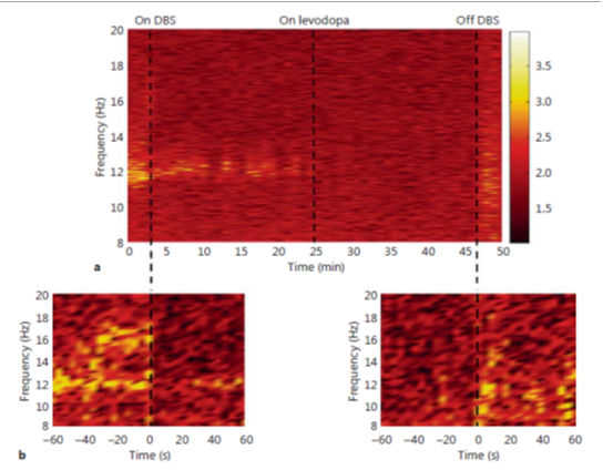 aTime-frequency plot of β-frequency LFPs (8Hz–20Hz) recorded from the STN during DBS initiation, Levodopa management and execution of stimulus PD-patient. b Distended outlook of the transition from DBS ‘off’ to DBS ‘on’ (left-side- panel) and similarly the other-way round (right-side-panel). DBS initiation is allied with a reduction in the power of β-fluctuations distinguished from a lead entrenched in the STN. The enduring elevated β-variations are fully eliminated via dopaminergic management. DBS annihilation is connected with an instant back of β-variations.