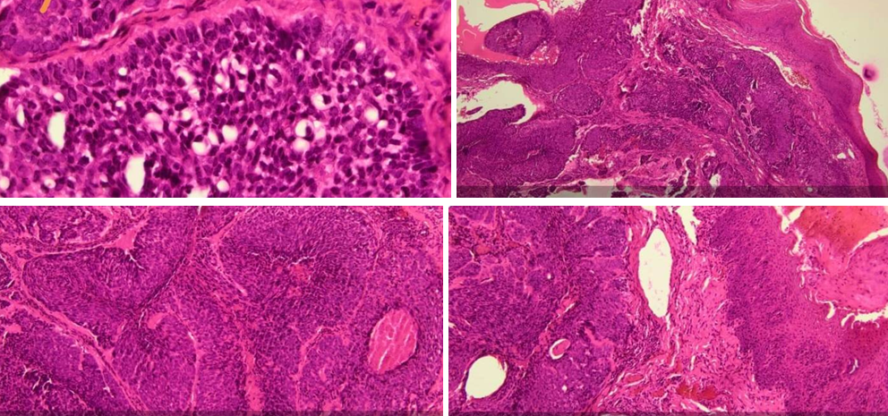 Histological sections showing infiltrating basaloid cells arranged in trabeculae