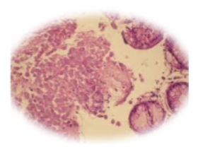 Photomicrograph of Amoebic colitis show sheets of tropozoites H&EX10