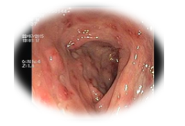 Photomicrograph of colonoscopic picture of abnormal mucosa in crohns disease H&EX10