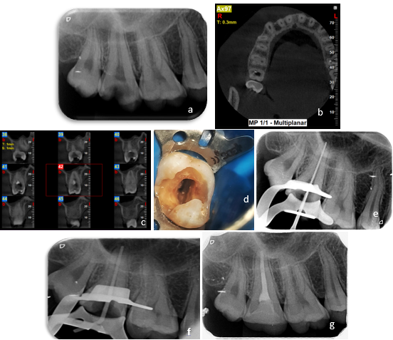 CASE 1 a: Pre-op Radiograph; b: CBCT axial view; c: CBCT coronal view; d: Access Opening; e: Working Length Radiograph; f: Master cone Radiograph, and g: Post-op radiograph